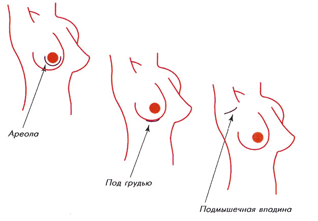 Места рассечения (разреза) груди