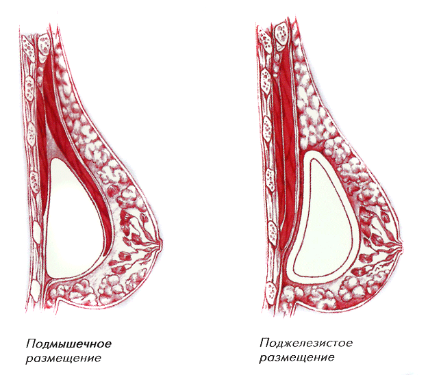 Размещение имплантов