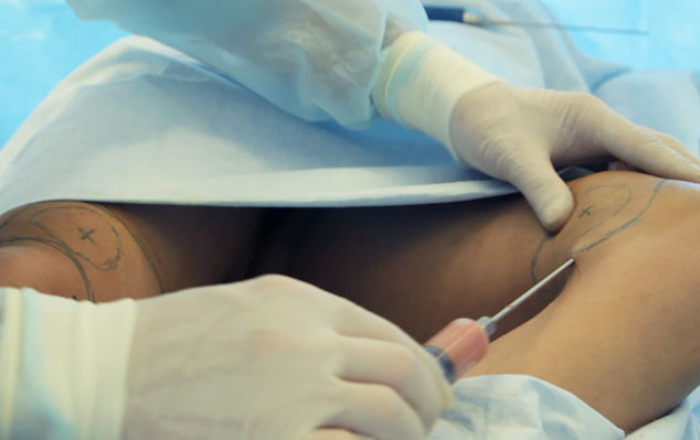lipos_knees.jpg