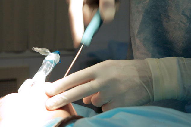 liposuction_chin.jpg
